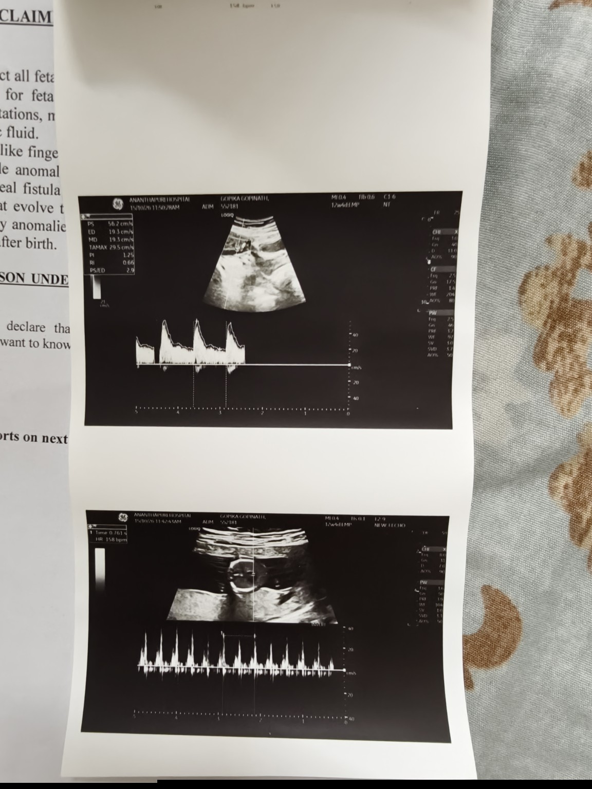 Complete original photograph of ultrasound waveform prints